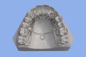 TMJ Splints